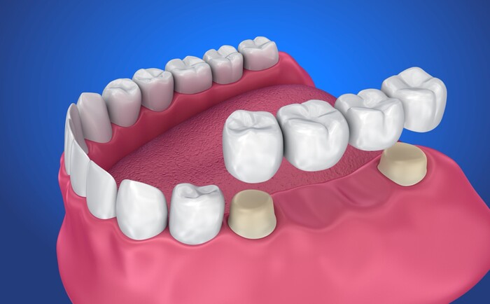 zirconia22