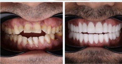 zirconia3